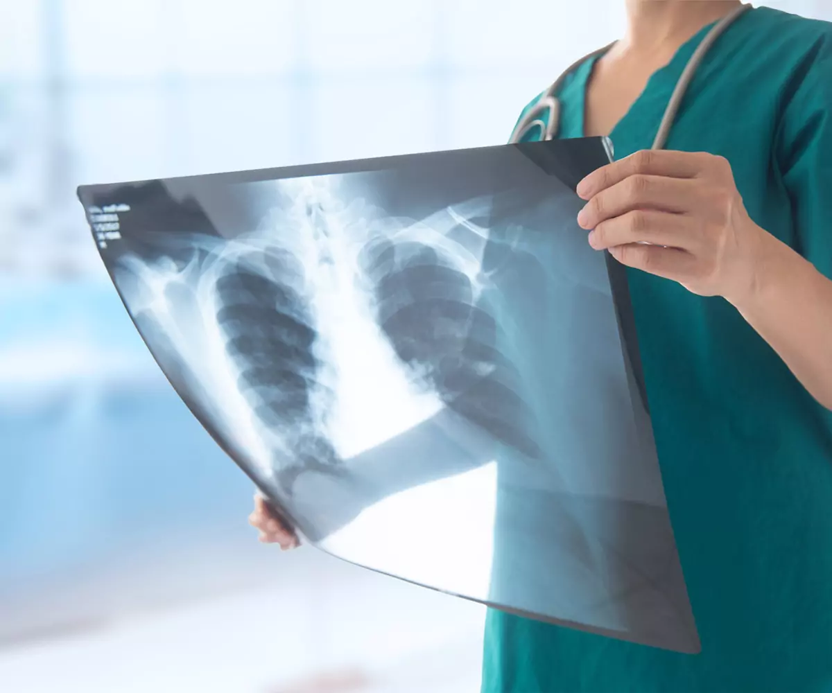 Global Aid Cuts Threaten Progress in the Fight Against Tuberculosis, WHO Warns A doctor examines a chest X-ray of a tuberculosis patient